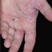 Allergie-ciment