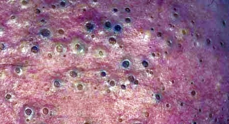 Chloracné