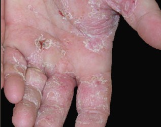 Aggravé atopitchesky la dermatite de la photo